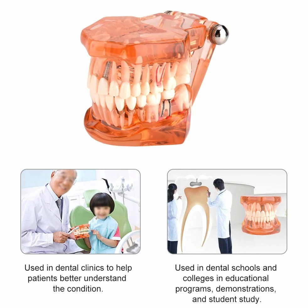Model zęba Model dentystyczny, zdejmowany model nauczania implantów dentystycznych Narzędzie demonstracyjne dentysty do nauki w szkole dentystycznej (pomarańczowy)