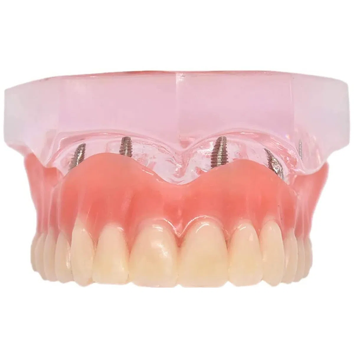 Standardowy model zębów, wyjmowana proteza Overdenture przezroczysty model odbudowy stomatologicznej dla stomatologii, edukacji i nauki.