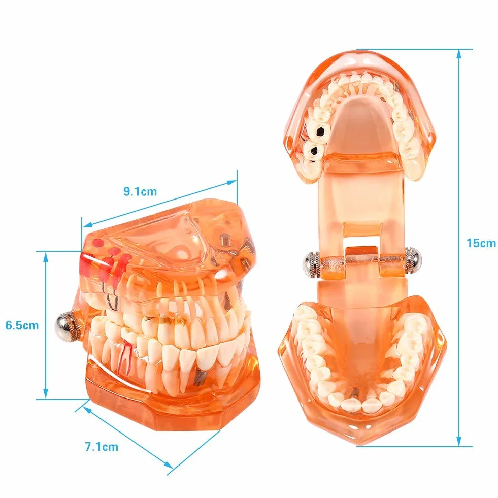 Model zęba Model dentystyczny, zdejmowany model nauczania implantów dentystycznych Narzędzie demonstracyjne dentysty do nauki w szkole dentystycznej (pomarańczowy)