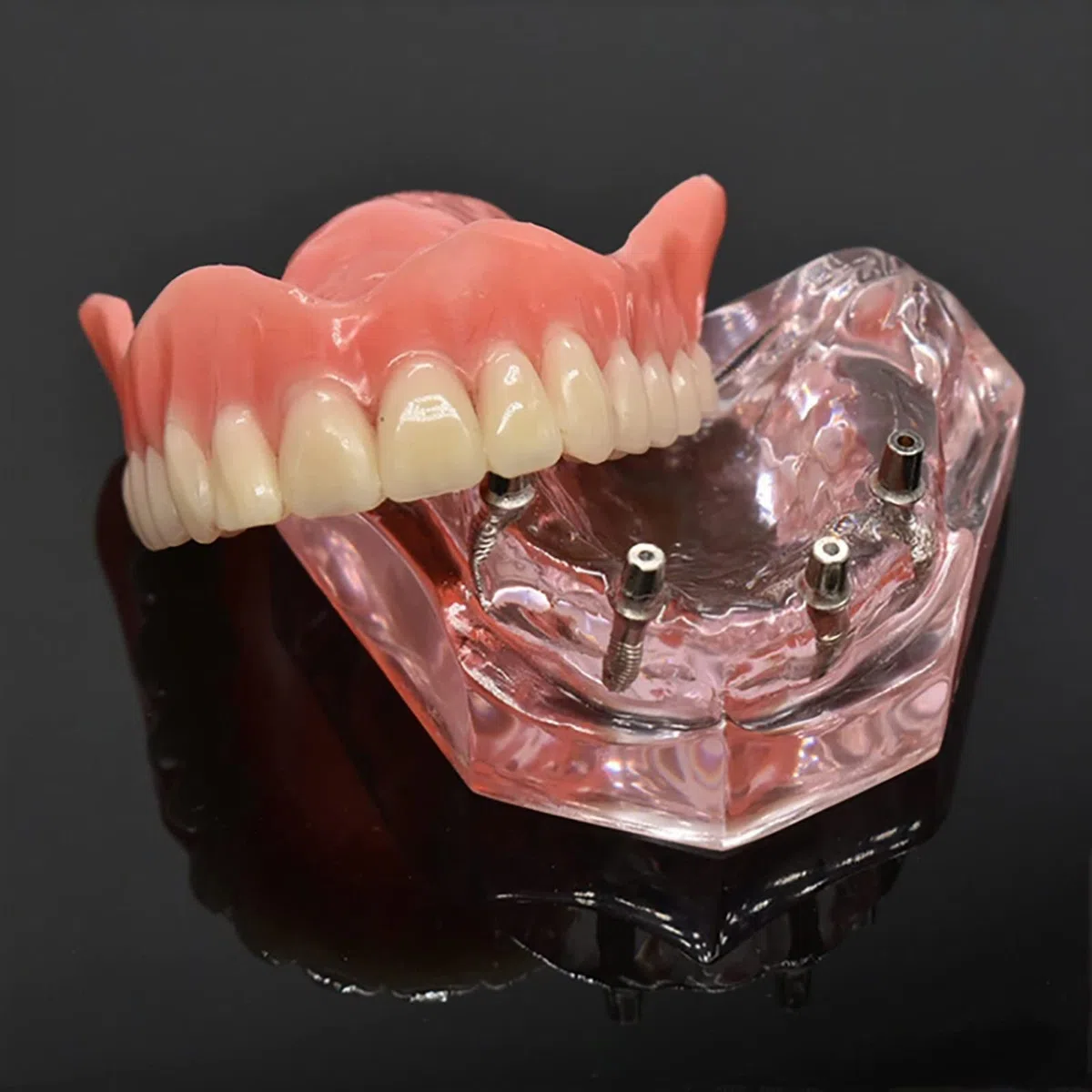 Standardowy model zębów, wyjmowana proteza Overdenture przezroczysty model odbudowy stomatologicznej dla stomatologii, edukacji i nauki.