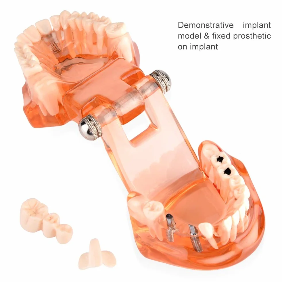 Model zęba Model dentystyczny, zdejmowany model nauczania implantów dentystycznych Narzędzie demonstracyjne dentysty do nauki w szkole dentystycznej (pomarańczowy)