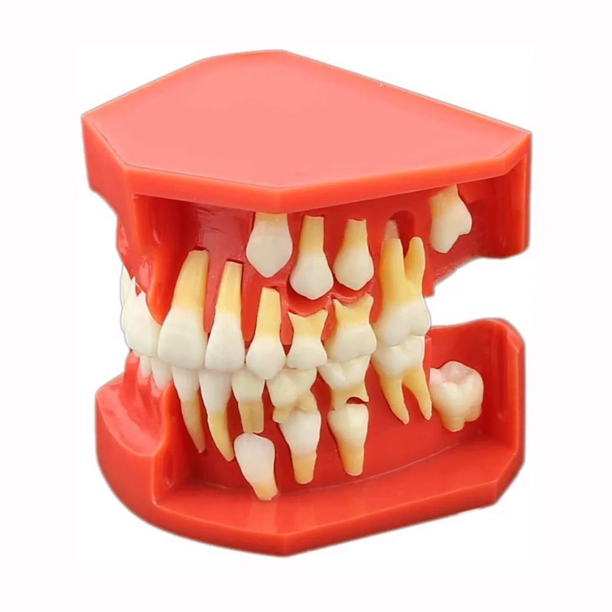 Zęby Dentystyczne Model Nauczania, Choroby Zębów Zdejmowane Zęby Model Demonstracyjny Zębów 9-12 Lat Dziecko Model Pielęgnacji Zębów Dentystycznych