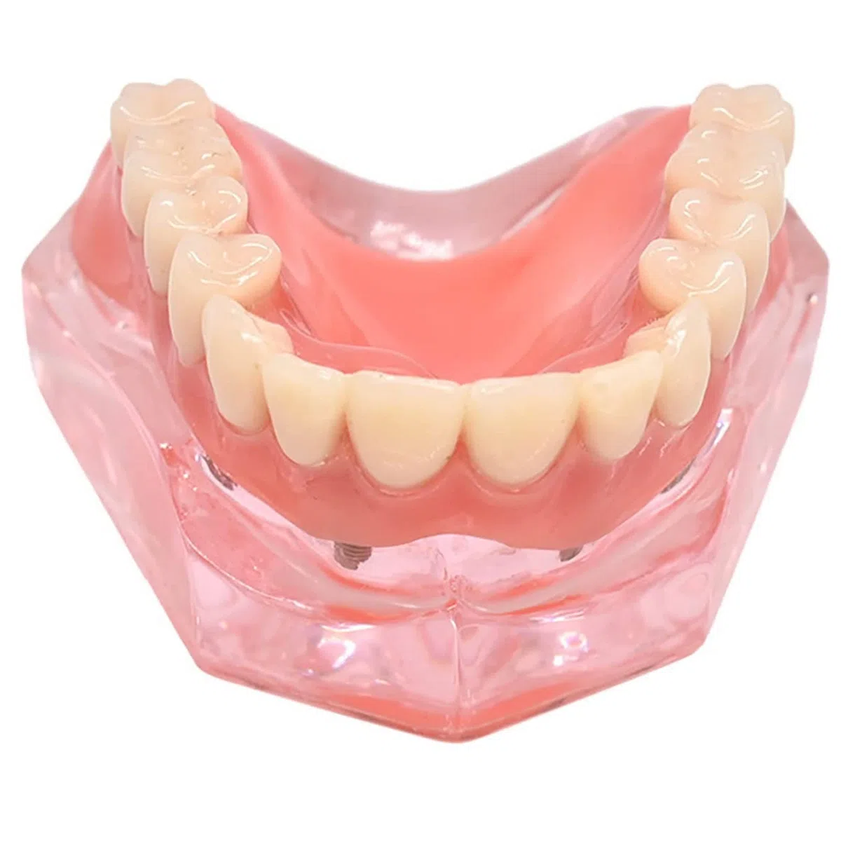 Standardowy model zębów, wyjmowana proteza Overdenture przezroczysty model odbudowy stomatologicznej dla stomatologii, edukacji i nauki.